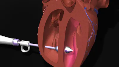 The non-invasive device, after being directed through a vein to the defect or hole in the heart, uses balloon technology to apply pressure and place the biodegradable patch over the defect. Then, as depicted in this digital rendering, UV light is emitted from the device and reflected inside the balloon, curing the patch. Afterwards, the device will be gently removed leaving the patch adhered in place.